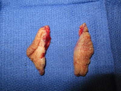 Vaginal mutilation — 11